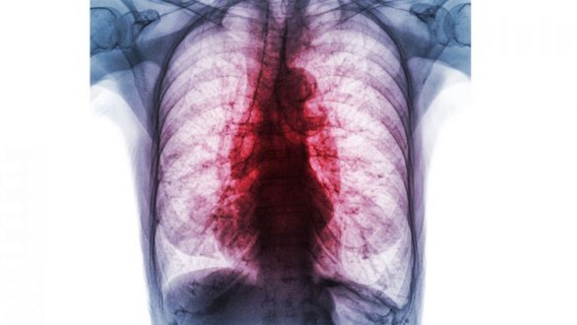 An x-ray showing the lungs of a person infected with pulmonary tuberculosis.