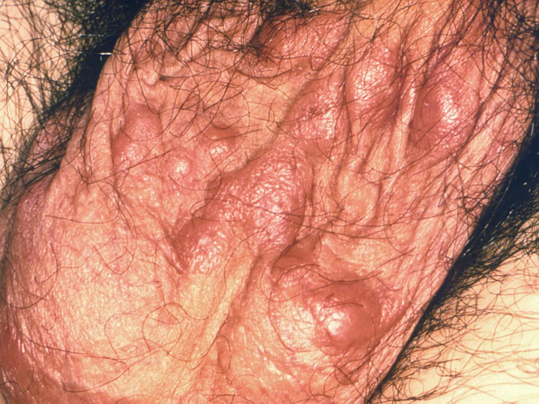 Scabies on scrotum <br />Image credit: CDC/ Dr. N.J. Fiumara; Dr. Gavin Hart, 1976</br>“><br /><em>Image credit: CDC/ Dr. N.J. Fiumara; Dr. Gavin Hart, 1976</em></div></p></div><div class=